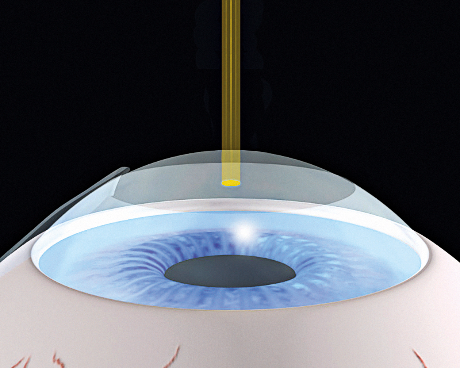 Schwind_LASIK